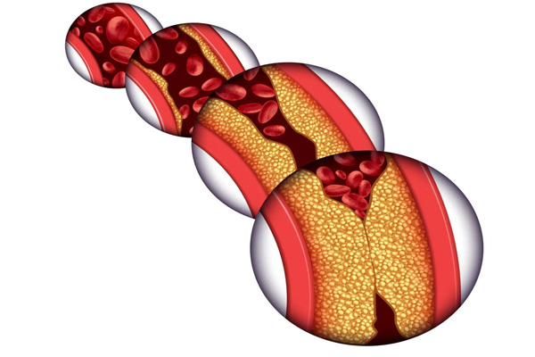 动脉粥样硬化,动脉粥样硬化的治疗,振东健康