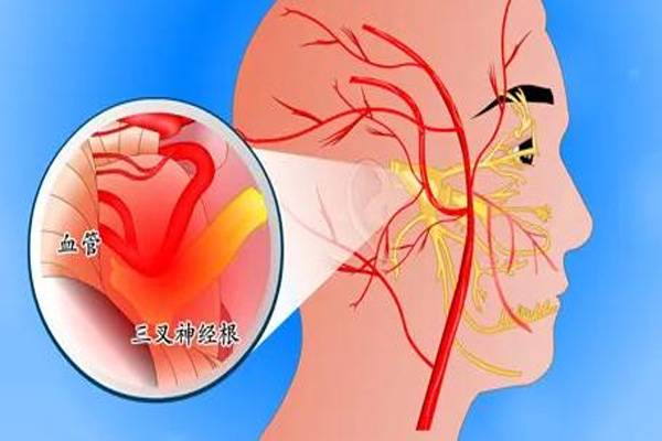 三叉神经痛,三叉神经痛症状,三叉神经痛症状的治疗,振东健康