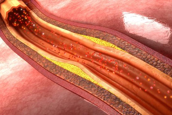 动脉硬化病症,动脉硬化病症的检测,振东健康