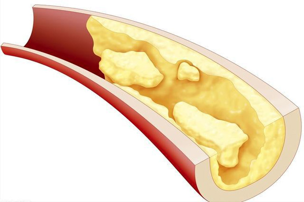 动脉粥样硬化症状,动脉粥样硬化症状的治疗,振东健康