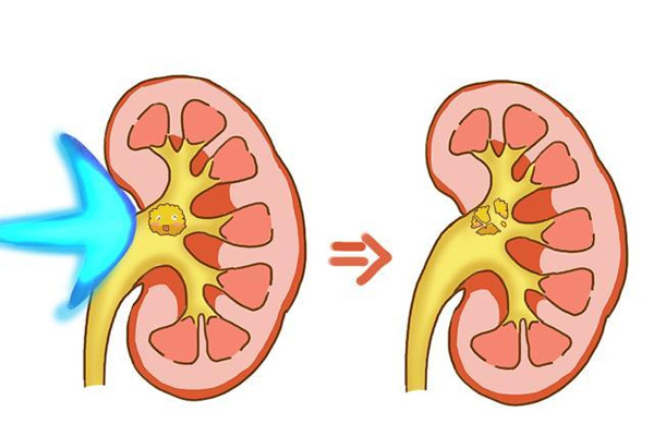 肾结石,肾结石症状,振东健康