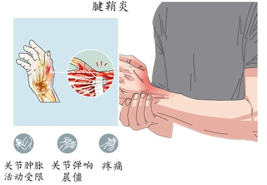 一,腱鞘炎症状的特征腱鞘炎主要影响肌腱周围的鞘膜组织,常见于手腕