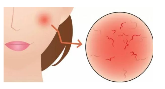 面部红血丝的原因，改善面部红血丝的方法