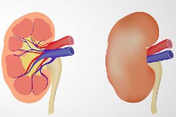 肾囊肿与劳累有关系,保护肾脏的方法