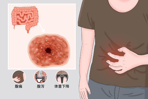 克罗恩病，克罗恩病症状