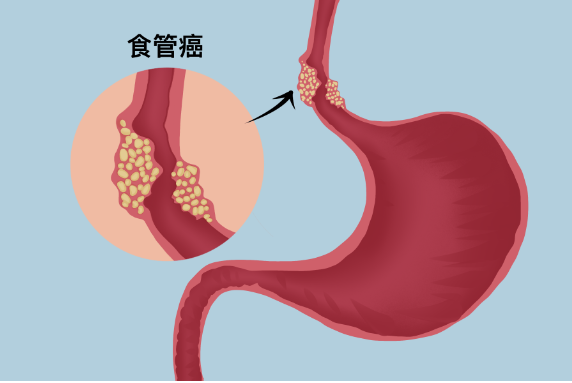 食管炎，食管炎转化成食管癌的概率