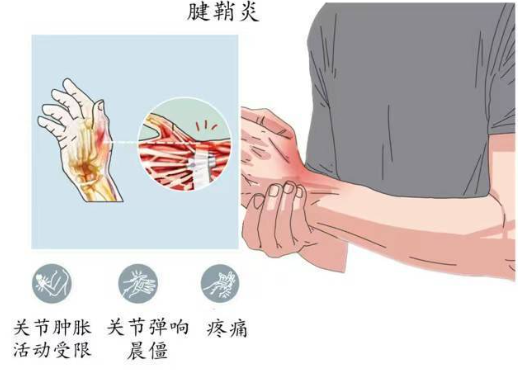 腱鞘炎，腱鞘炎症状