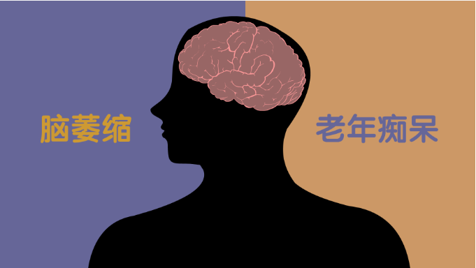 脑萎缩和老年痴呆的联系和区分