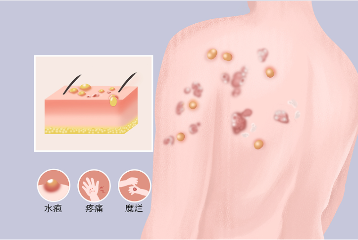 天疱疮，天疱疮症状