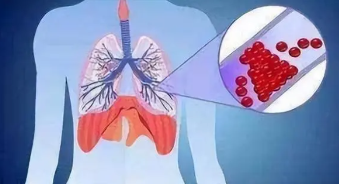 肺栓塞，肺栓塞的危险性