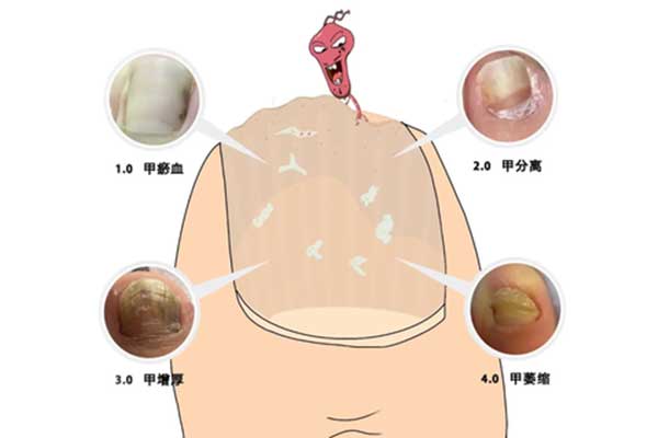 治疗灰指甲复发的方法,导致灰指甲的不良习惯