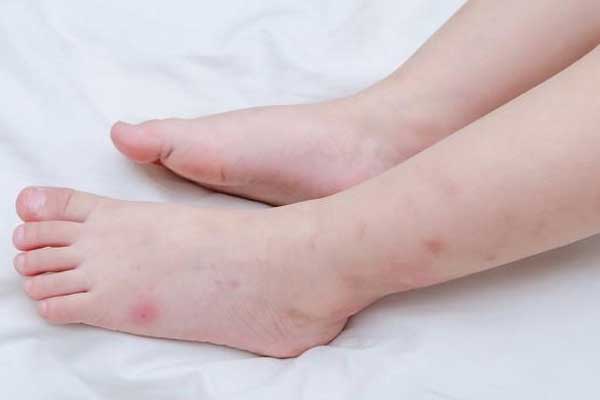 虫咬性皮炎有什么反应？