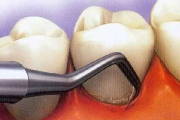 牙龈疾病,常见的牙龈疾病