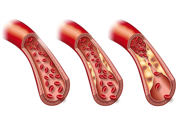 动脉硬化,动脉硬化的危害