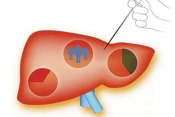 肝病,肝病高发的原因