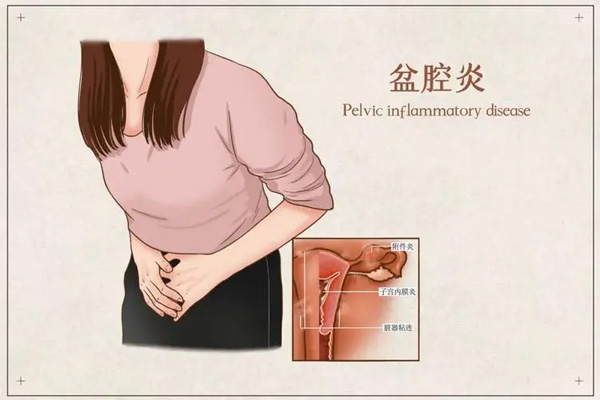 盆腔炎,盆腔炎症状,振东健康