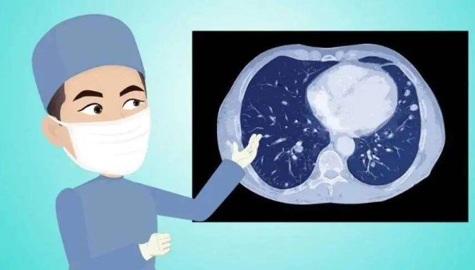 肺结节，肺结节判断方法