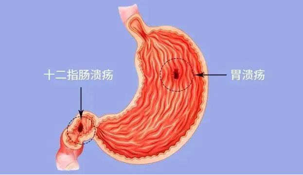 消化性溃疡，消化性溃疡的成因