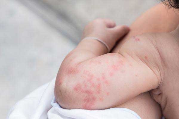 冬季荨麻疹反复的原因,冬季荨麻疹的注意事项