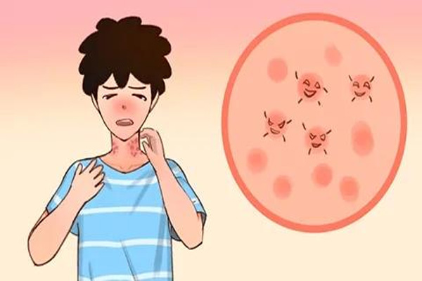 荨麻疹症状,荨麻疹症状的传染性,振东健康