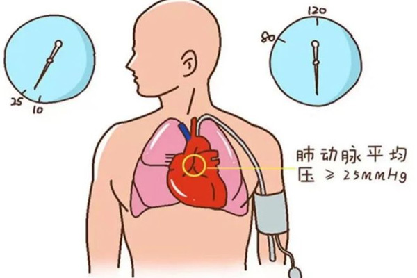 肺动脉高压的症状,肺动脉高压的症状表现,振东健康