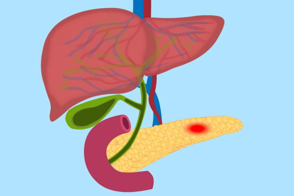 胰腺炎,胰腺炎的症状