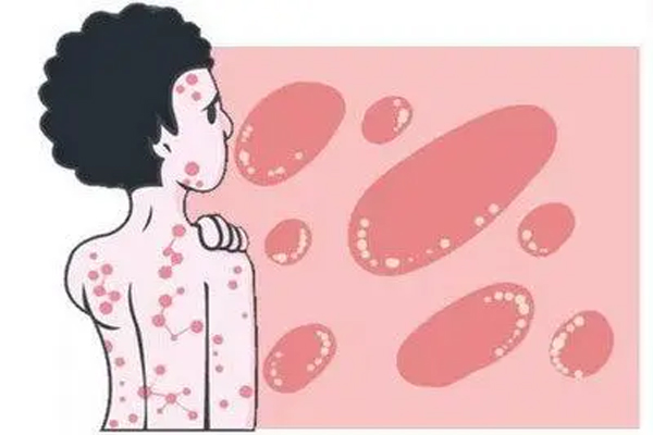 荨麻疹,荨麻疹的类型