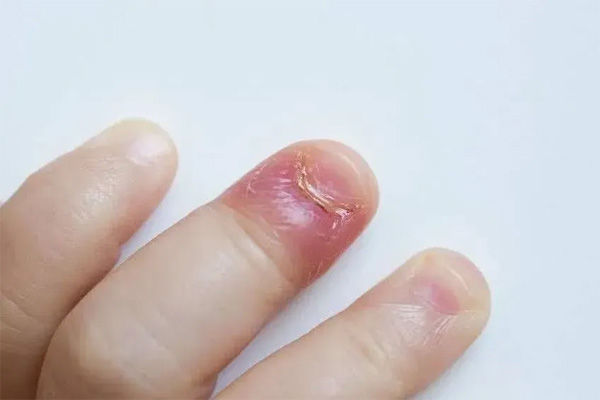 预防手指甲沟炎应该怎么做？