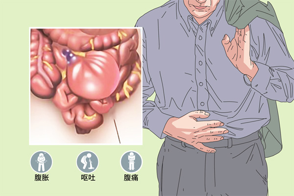 肠梗阻,肠梗阻症状,振东健康