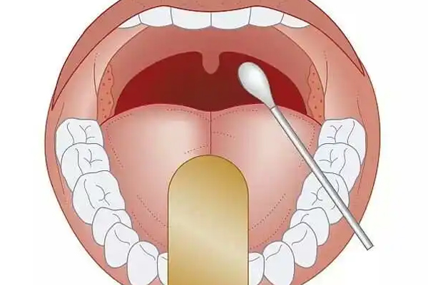 牙周炎,治疗牙周炎的方法