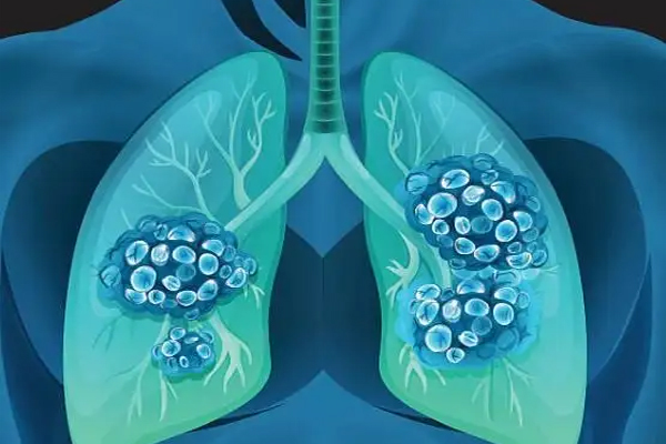 肺癌,肺癌中晚期