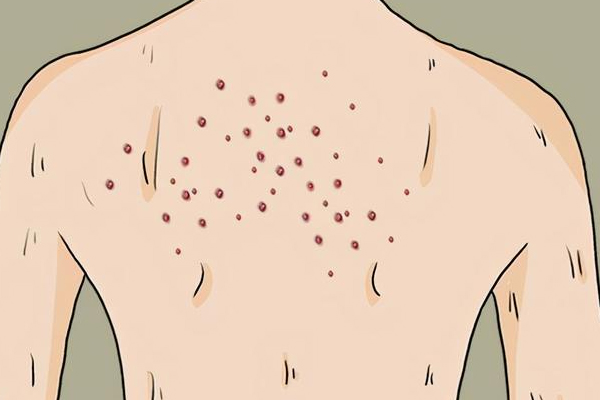 湿疹,痱子,湿疹和痱子的区别